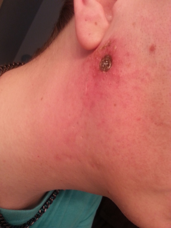 Day 3 of my Black Salve Treatment on a Cancerous Mole on my face.